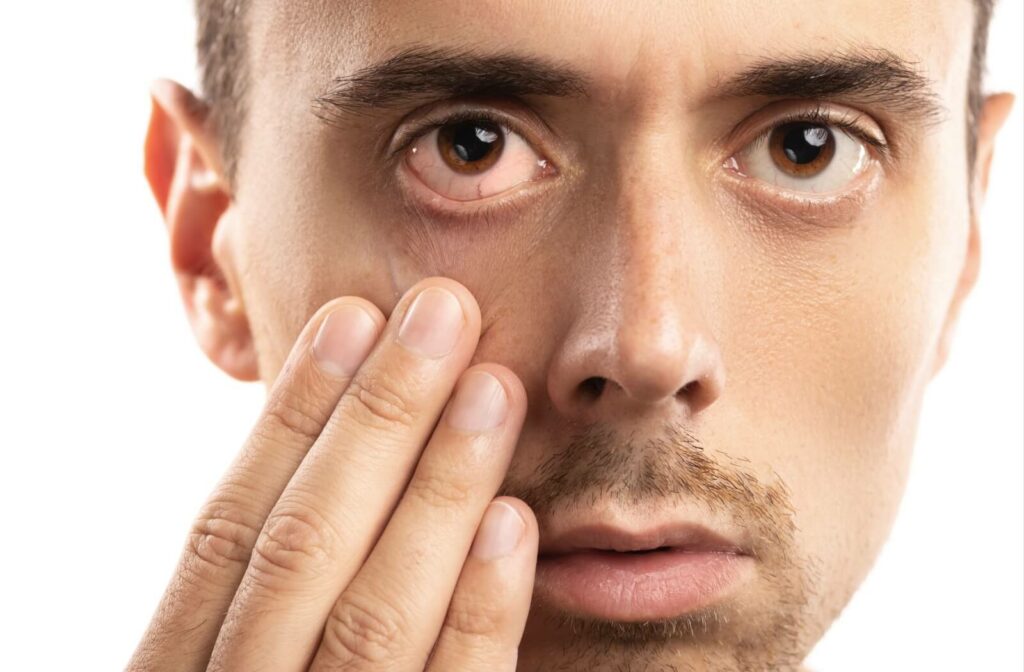 A person touching the area under their eye, showing redness and discomfort, possibly from dry eyes.