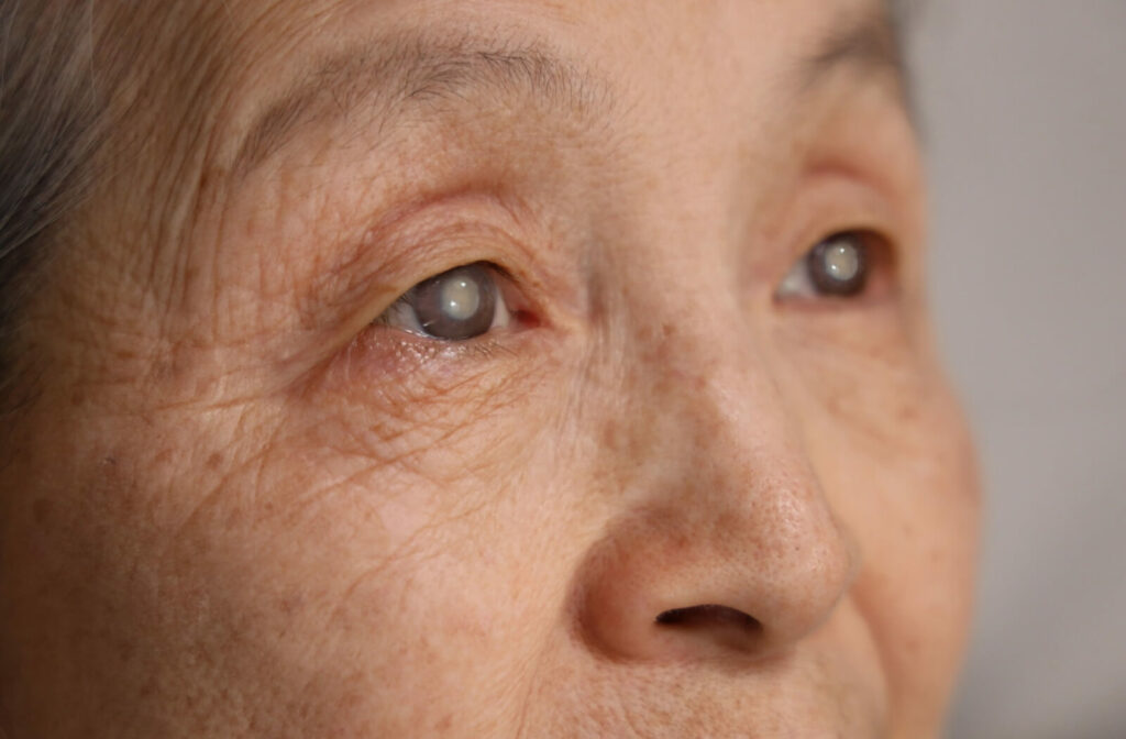 Close-up of a senior woman's eyes with cloudy grey pupils.